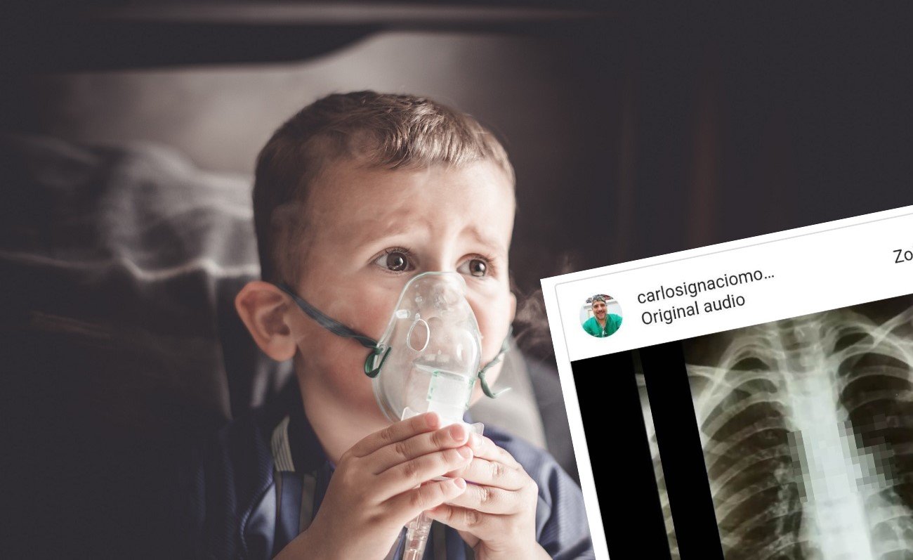 Badanie RTG płuc dziecka wykazało, że połknął sprężynę
