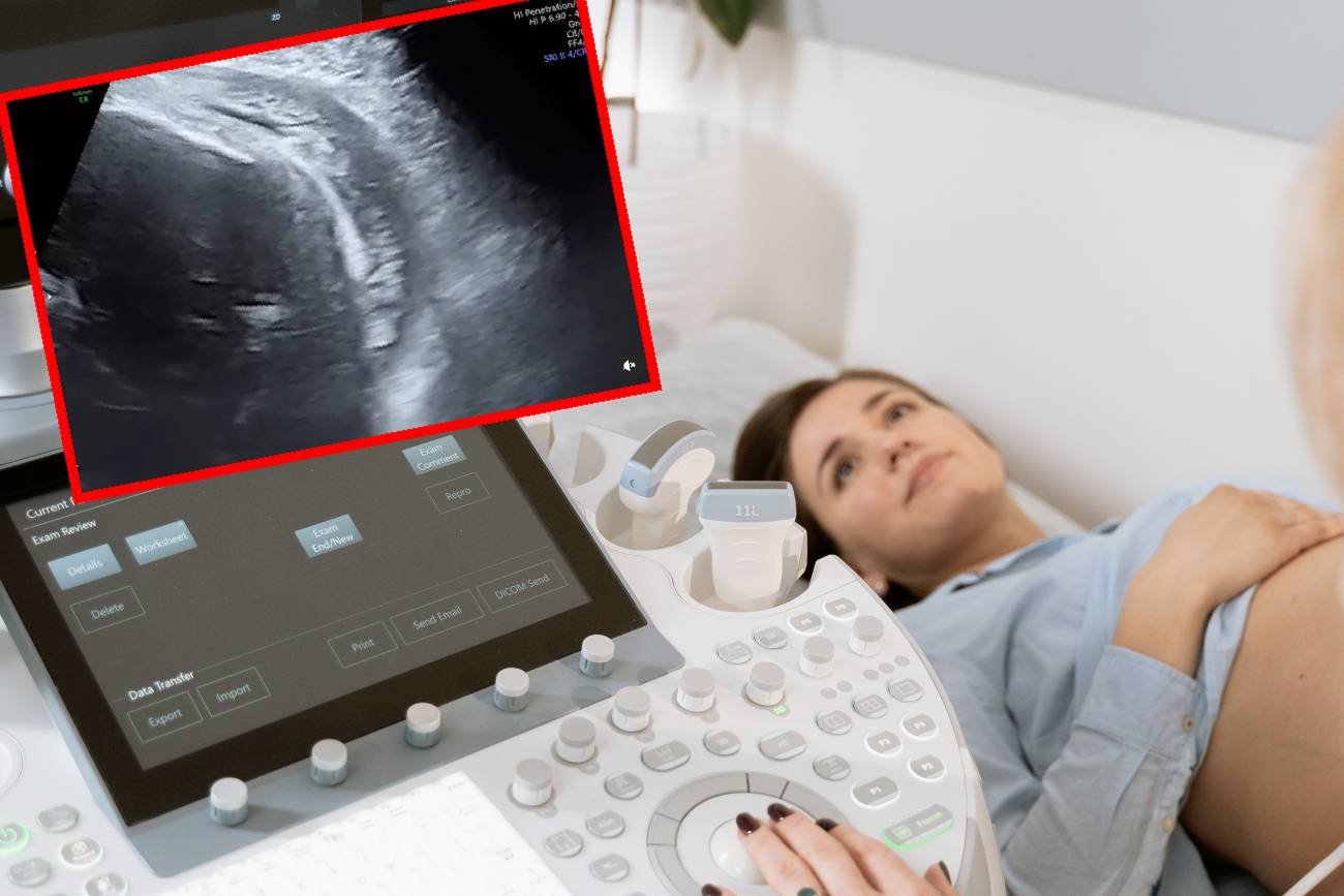 usg w ciąży, obraz na usg, usg, badanie ultrasonograficzne, badanie usg, obraz dziecka na usg
