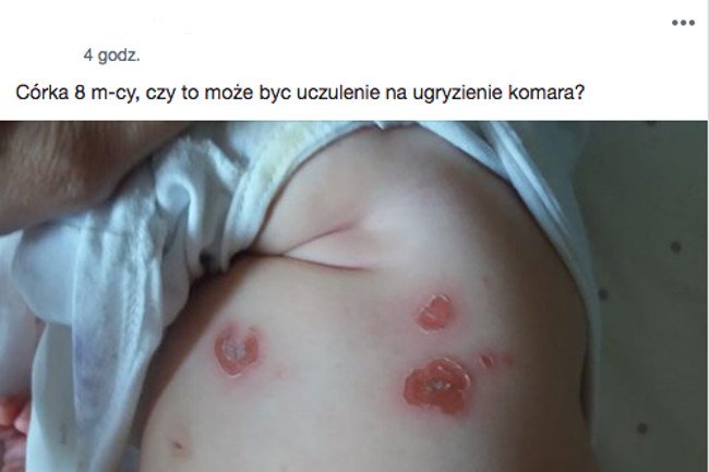 Alergia na ugryzienie komara – czym się charakteryzuje?
