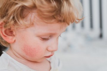 wstrząs anafilaktyczny na zdjęciu