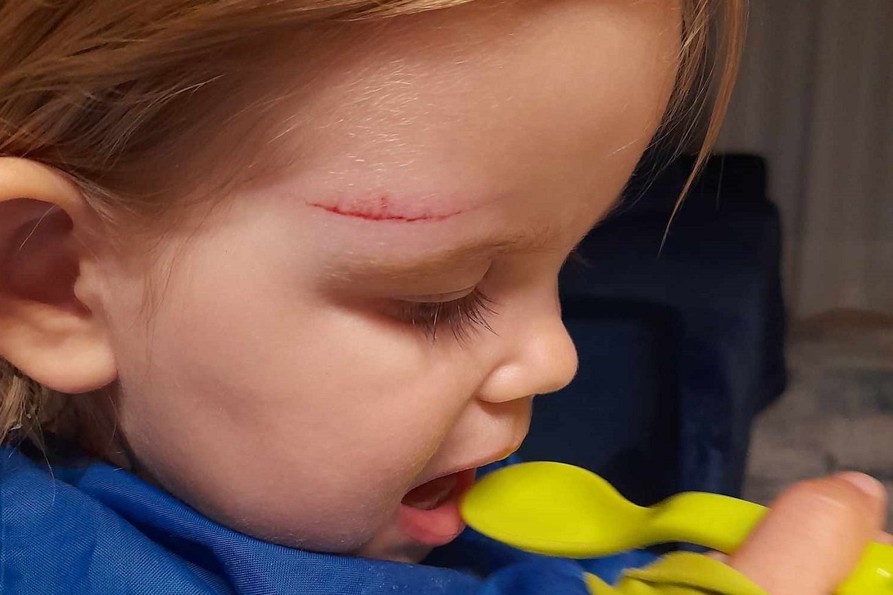 Uraz głowy u dziecka