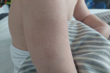 Dziecko z wysypką typową dla szkarlatyny.
