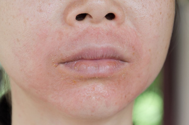 Wiele dzieci i dorosłych walczy z chorobą, która naprawdę jest wyjątkowo uciążliwa.