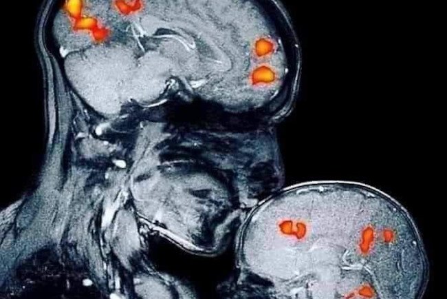 Co się dzieje, gdy mama całuje dziecko w czoło? Fajkowe zdjęcie rezonansu Co się dzieje, gdy mama całuje dziecko w czoło? Fajkowe zdjęcie rezonansu