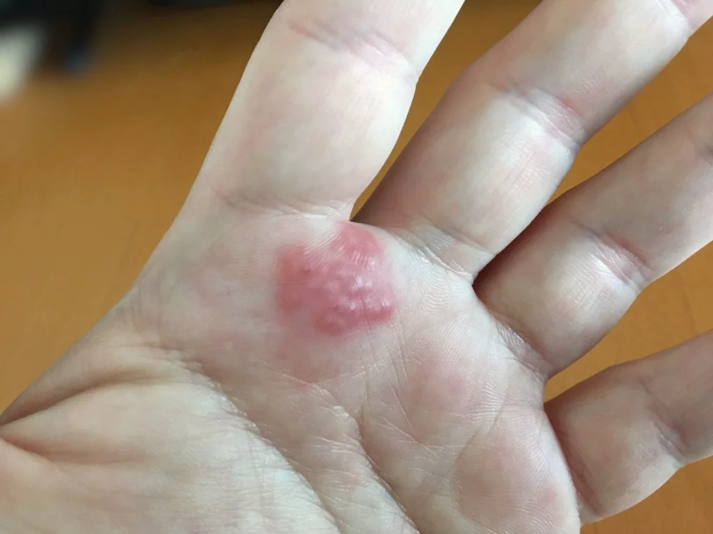 Alergia kontaktowa na dłoni: zdjęcie