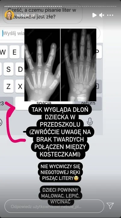 Zdjęcie rtg ręki dziecka, które od najmłodszych lat uczyło się pisania - chrząstki skostniały zbyt szybko.