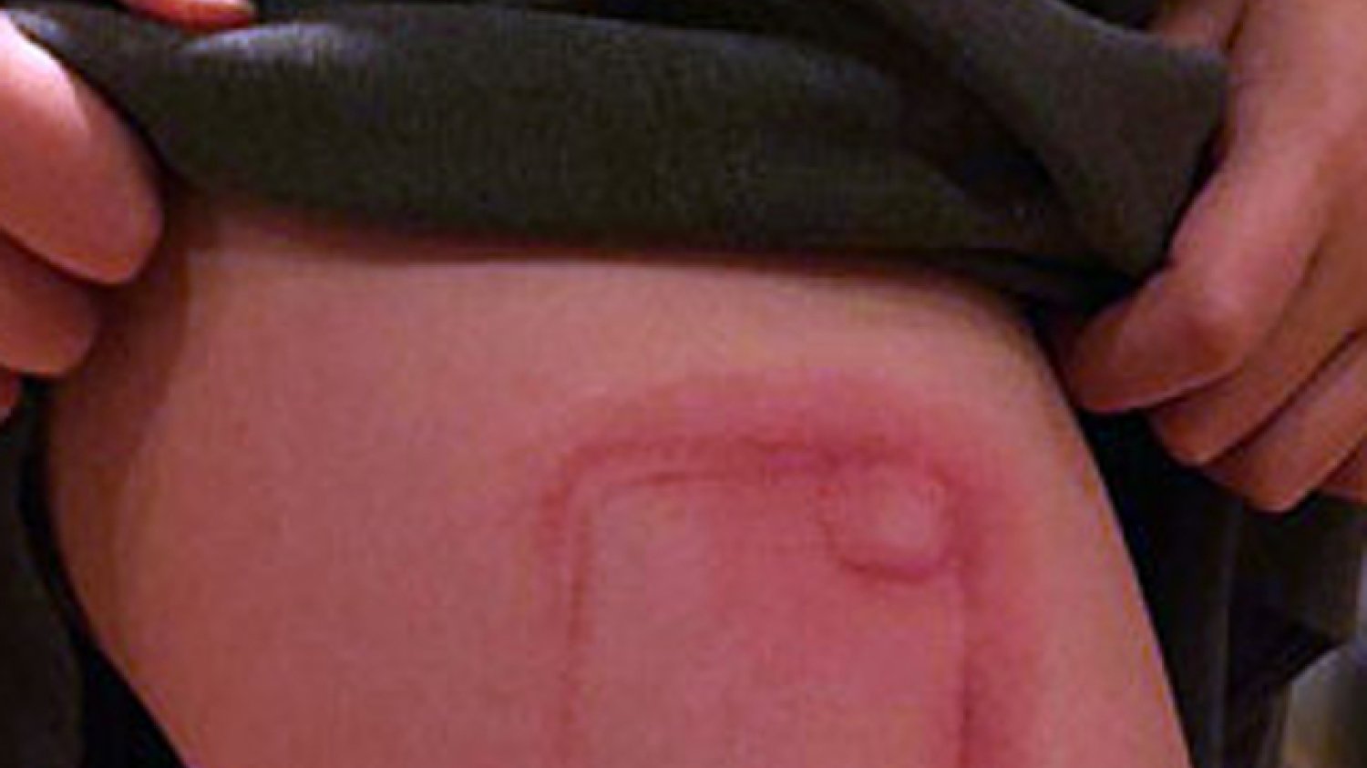 Fot. [url=http://www.telegraph.co.uk/news/newstopics/howaboutthat/12096634/Girl-nine-has-iPhone-shaped-scar-for-life-after-case-leaks-toxic-glitter-onto-her-leg.html] The Telegraph[/url]