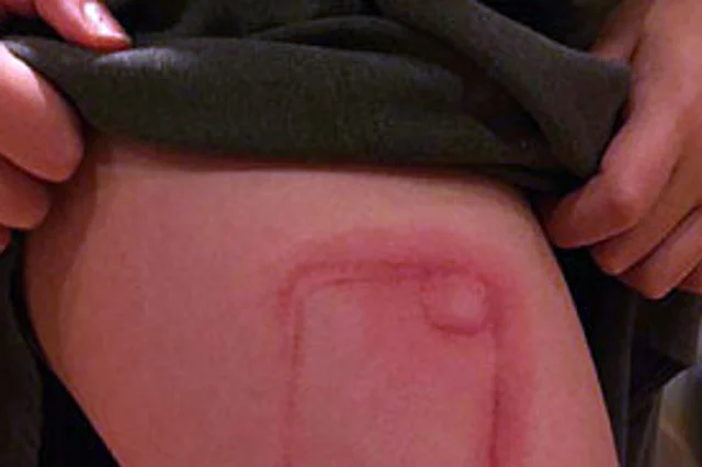 Fot. [url=http://www.telegraph.co.uk/news/newstopics/howaboutthat/12096634/Girl-nine-has-iPhone-shaped-scar-for-life-after-case-leaks-toxic-glitter-onto-her-leg.html] The Telegraph[/url]