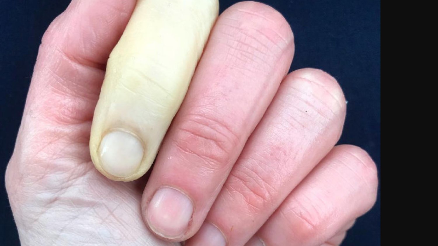 Co to jest zaburzenie Raynauda? Jenni Falconer