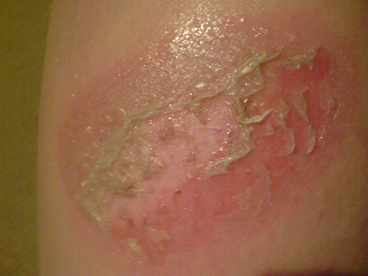 Oparzenie słoneczne II stopnia.