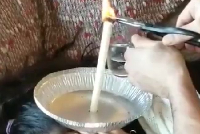 Tak wygląda świecowanie uszu.