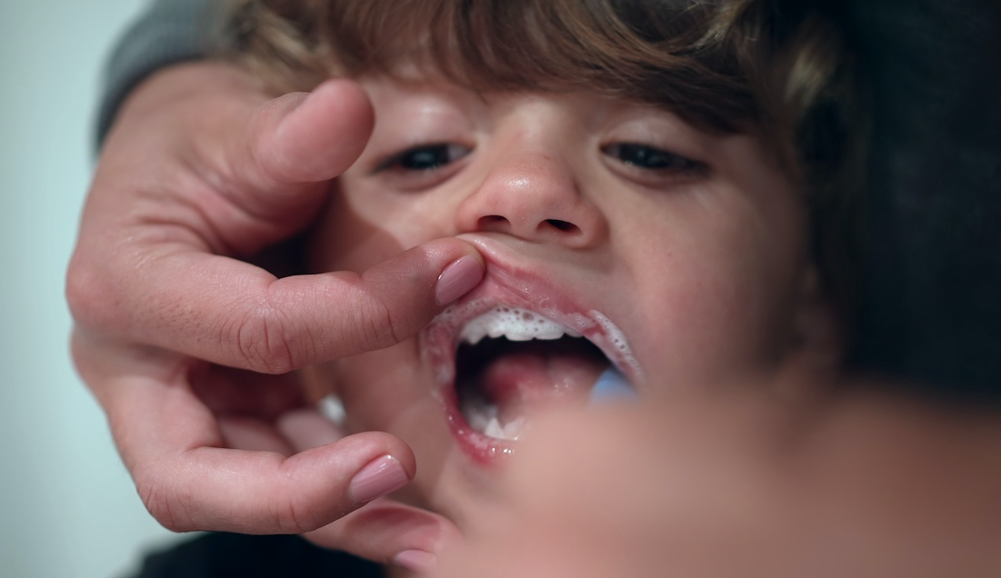 70 proc. dzieci w Polsce ma próchnicę. Dentysta ostrzega: rodzice popełniają jeden błąd