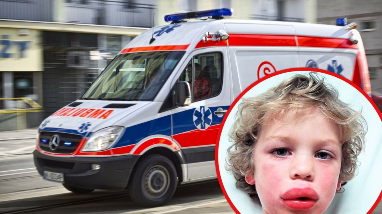 Wstrząs anafilaktyczny: objawy, podanie adrenaliny