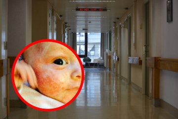 alergia na zimno, uczulenie na zimno, alergie, reakcje alergiczne, pokrzywka u dziecka, alergie u dziecka