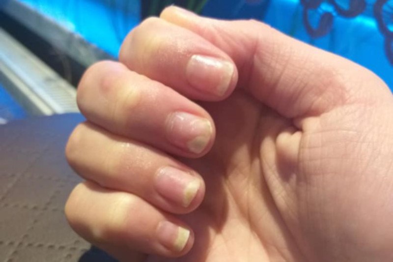 Manicure hybrydowy może wywoływać uczulenia.