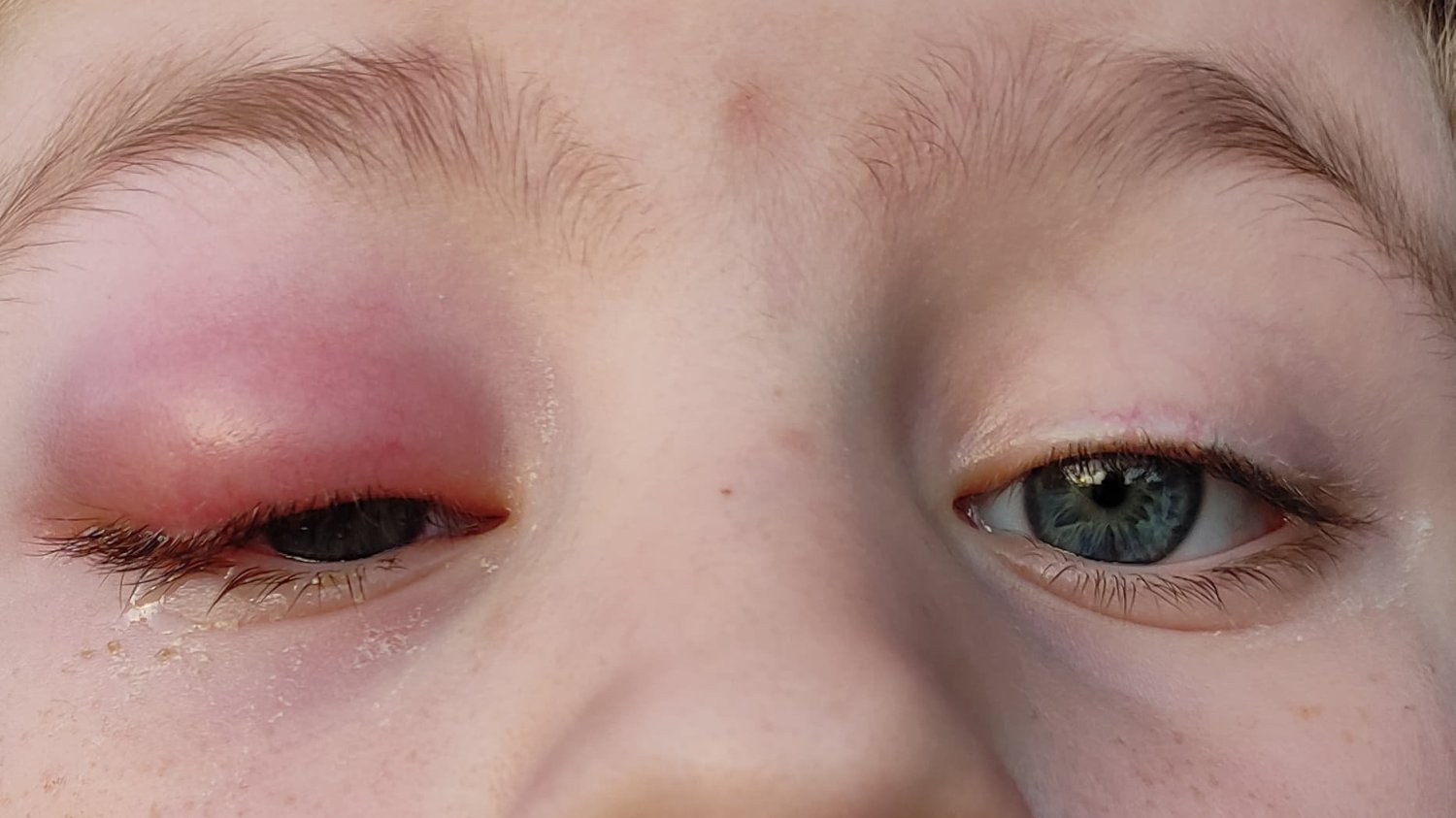 reakcja alergiczna przy jednym z rodzajów alergii