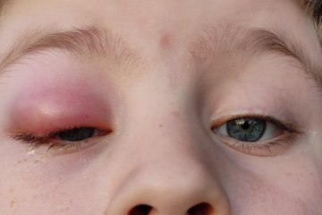 reakcja alergiczna przy jednym z rodzajów alergii