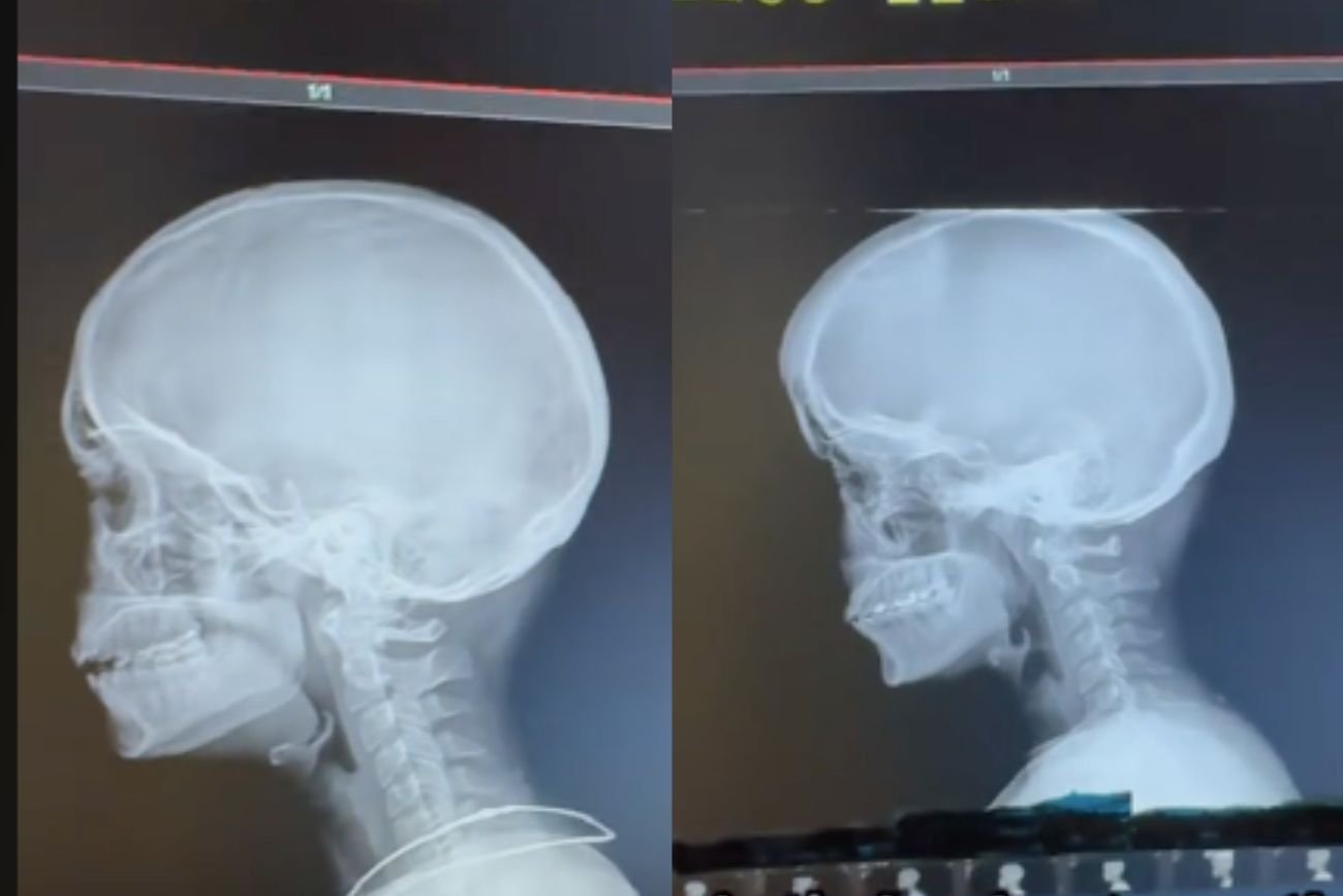 zdjęcia rentgenowskie kręgosłupa