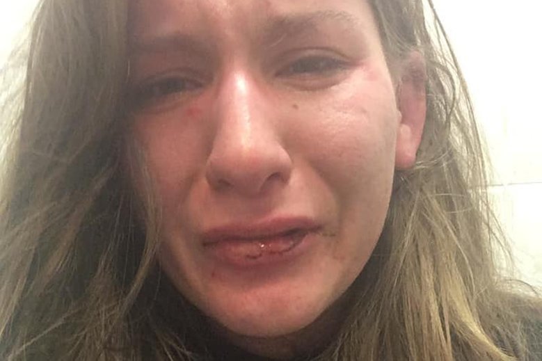 Aleksandra została pobita na ulicy w Łodzi