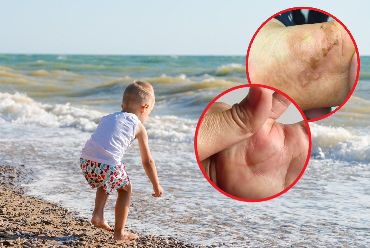 Robaki pod skórą dziecka? Uwaga na niebezpieczną pamiątkę z plaży