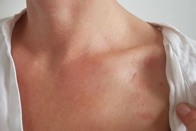 alergia na hybrydę: wysypka na ciele