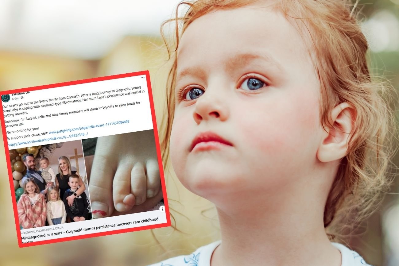 Lekarze mówili, iż to niegroźna brodawka. Po 730 dniach dziecko dostało bolesną diagnozę