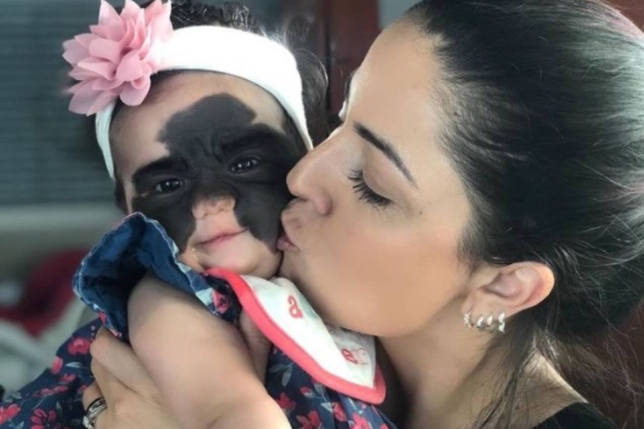 Mama całuje dziewczynkę, która ma znamię na twarzy