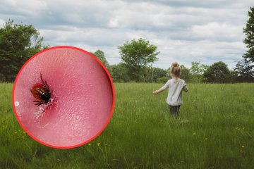 Kleszcz wbity w tylną część płatka ucha dziecka.
