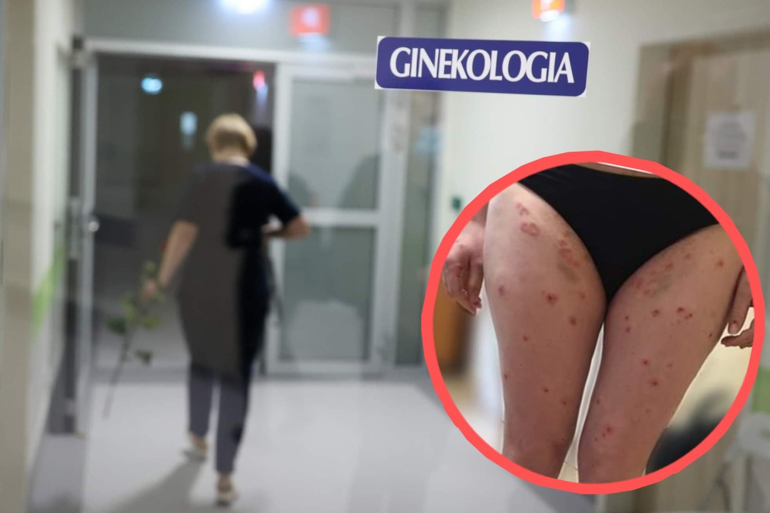 Pemfigoid ciężarnych: opryszczka ciężarnych, objawy, leczenie, przyczyny