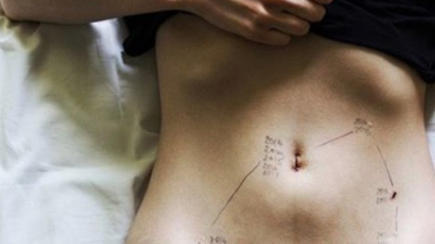 Endometrioza dotyka co 5 kobiety.