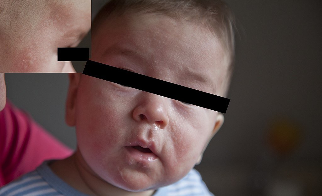 wysypka przy alergii na mleko
