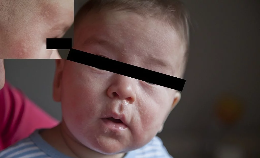 wysypka przy alergii na mleko