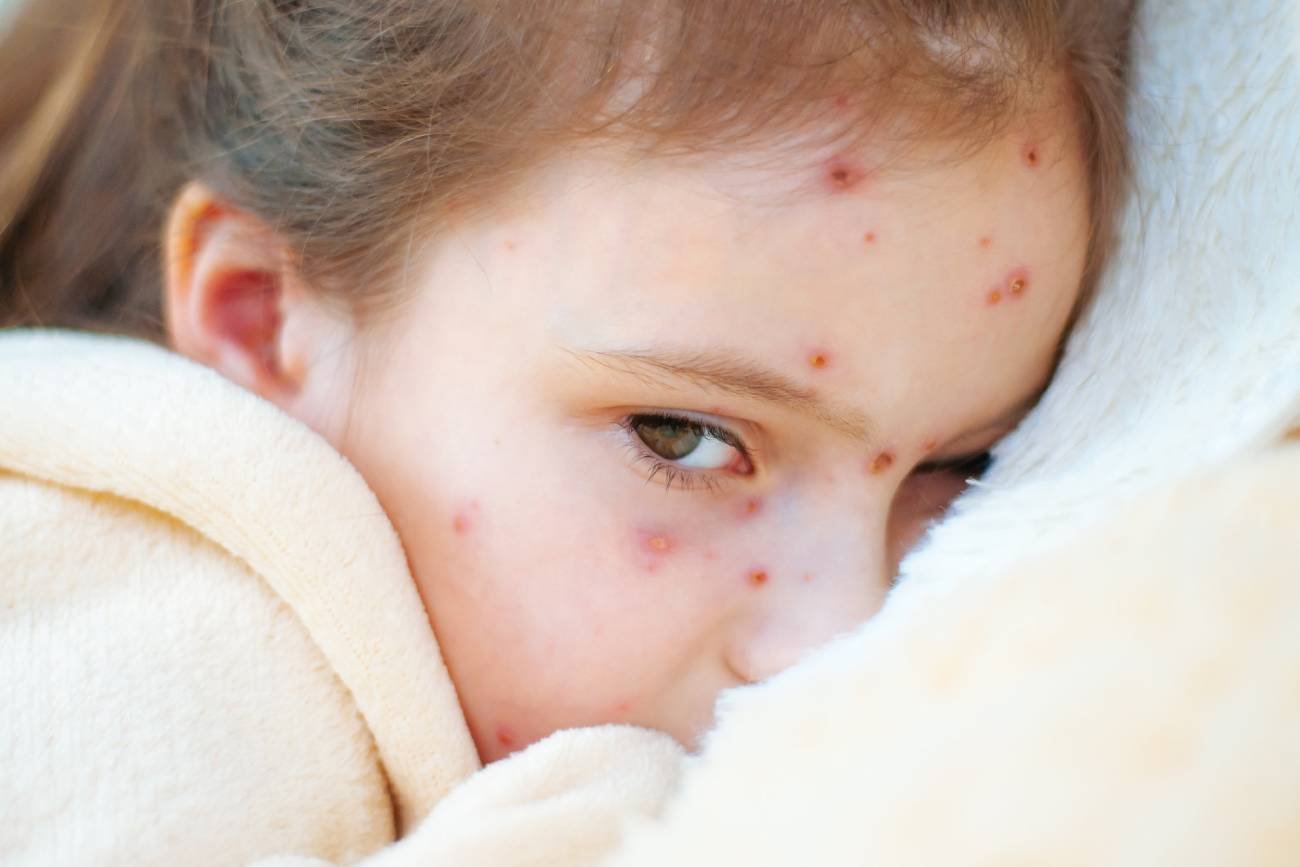 ospa wietrzna, zakażenie ospą, ospa w przedszkolu, jak wzmocnić odporność, izolacja przed chorobami, chorowanie w przedszkolu