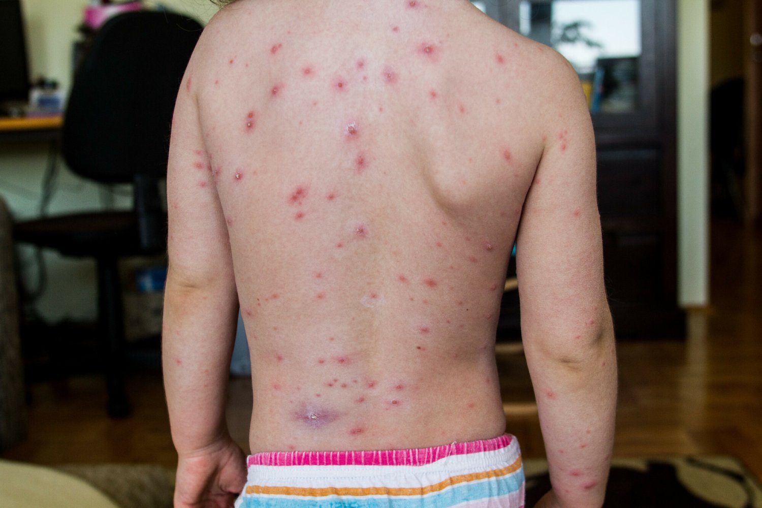 Powrót ospy, odry, świnki, różyczki i szkarlatyny. Tak źle dawno nie było