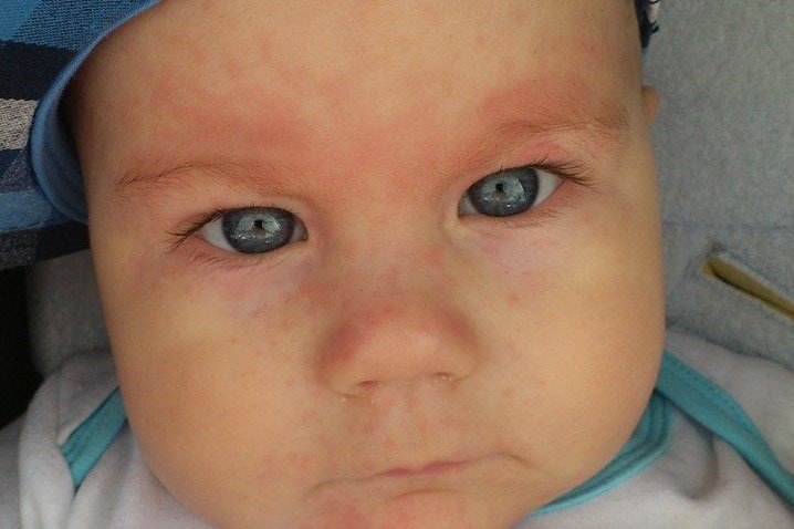 Trzydniówka, wysypka po trzydniówce, rumień nagły