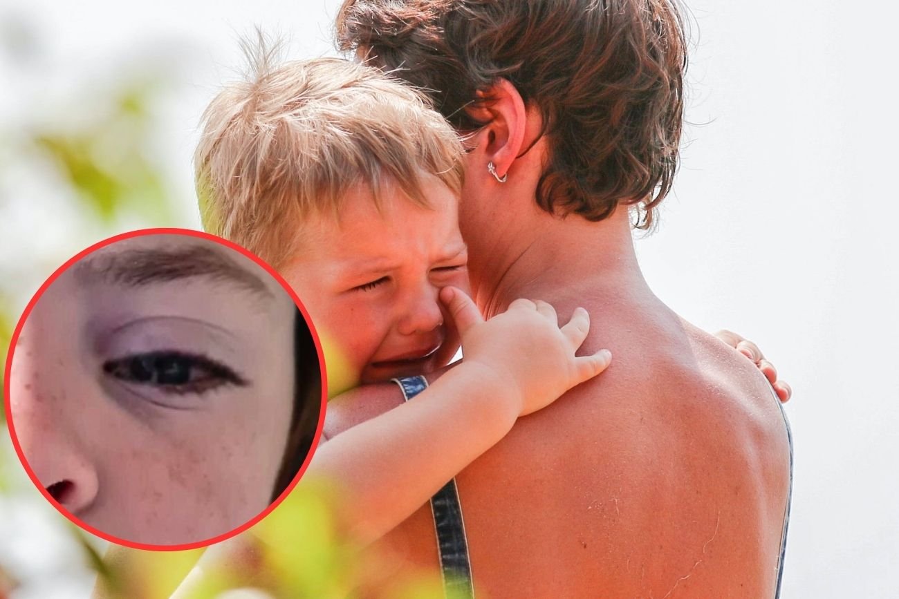 Chłopiec płacze z powodu swędzących latem oczu.