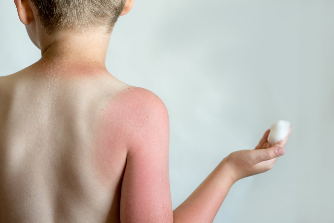 parzenie słoneczne u dziecka.