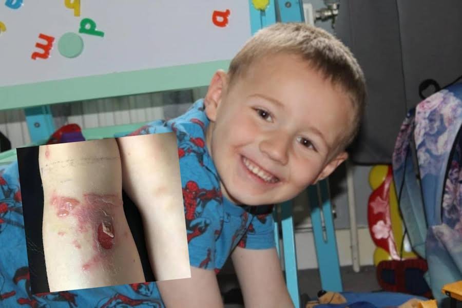 6-letni chłopiec i rana