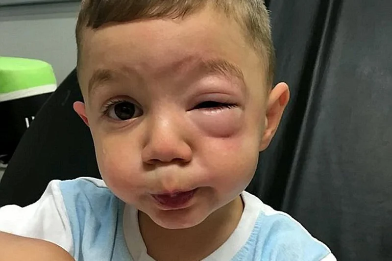 2-letni chłopiec doznał silnej reakcji alergicznej