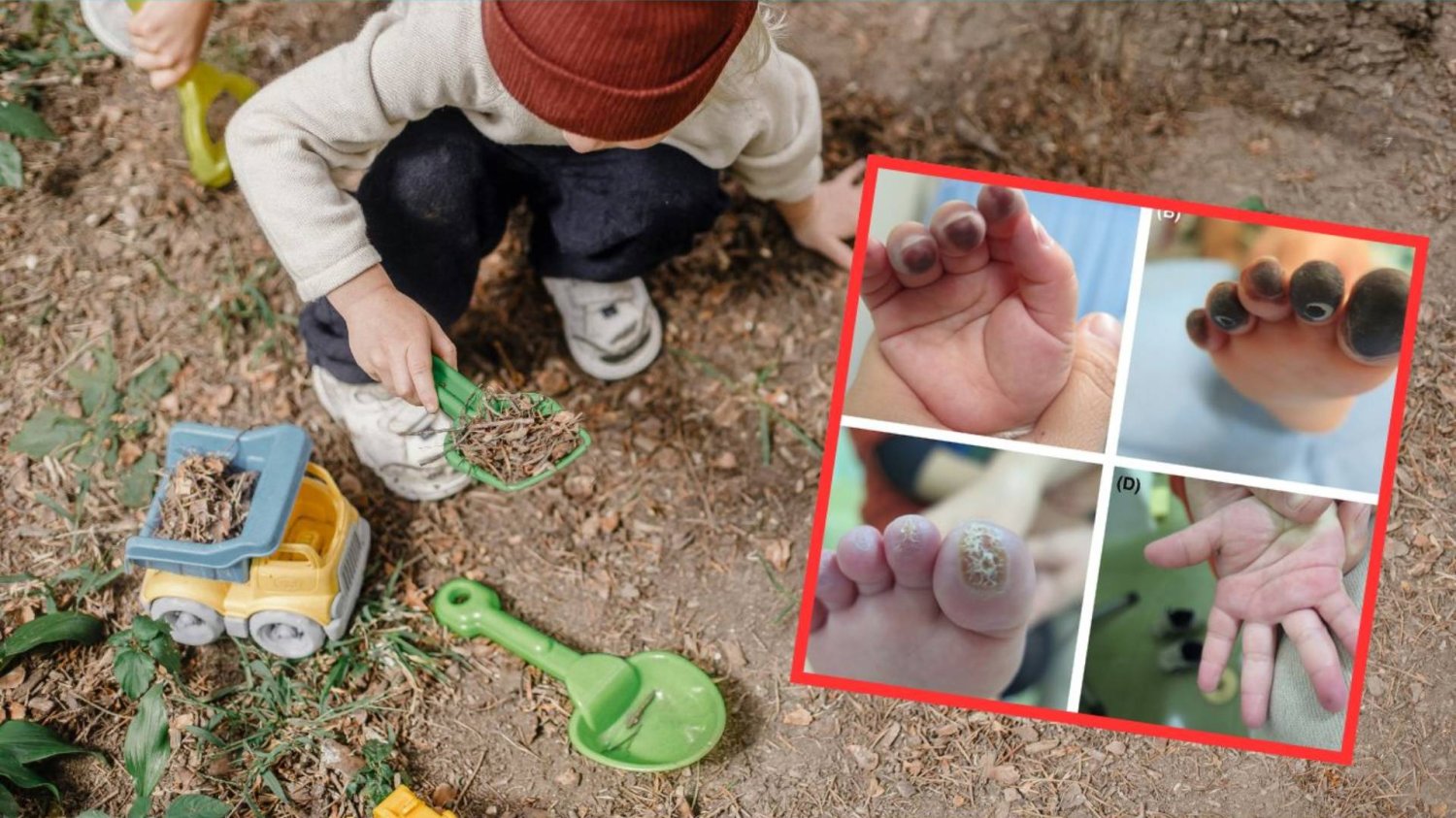 zasinione palce u dziecka z objawem Raynauda zasinione palce u dziecka z objawem Raynauda