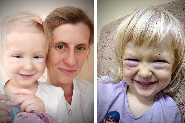 hipoplazja nerwu wzrokowego