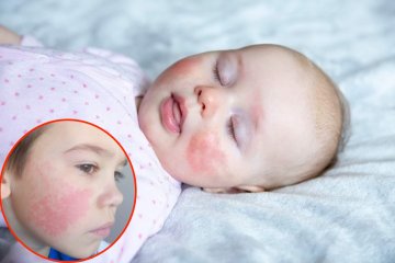 Rumień zakaźny u dziecka Rumień zakaźny u dziecka