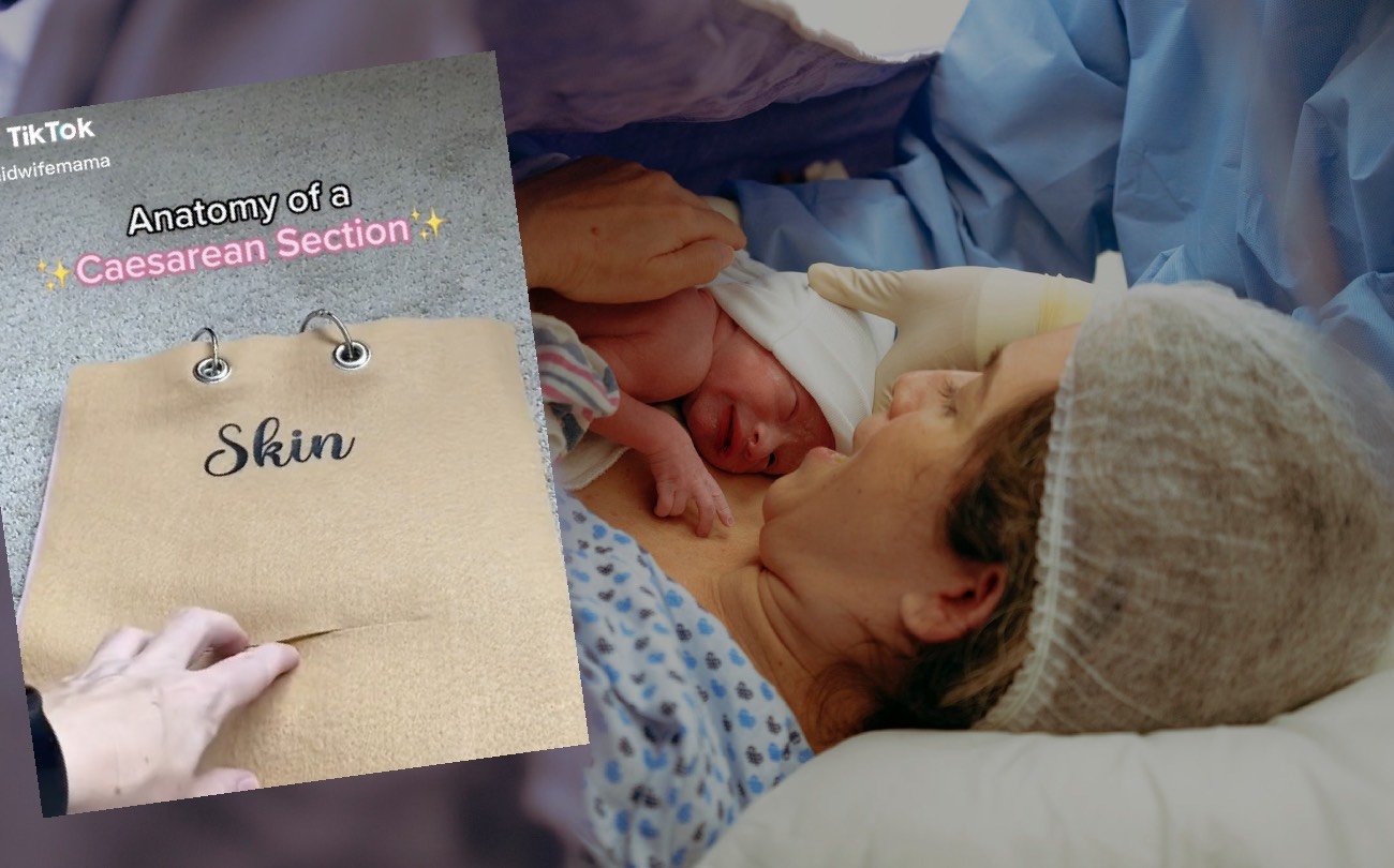 Kobieta rodząca dziecko metodą cesarskiego cięcia.