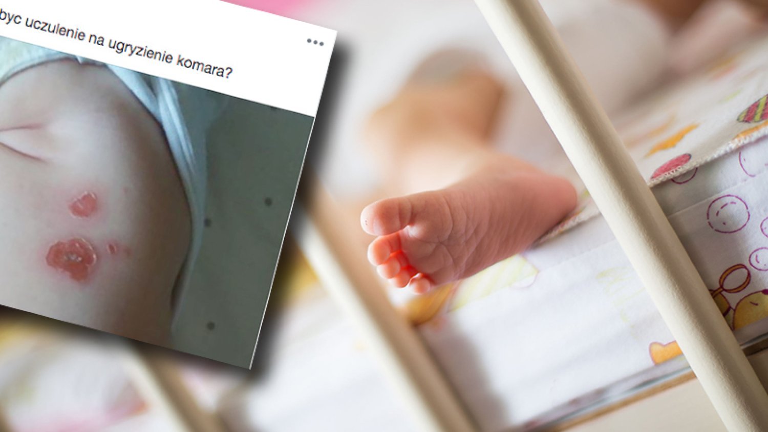 Uczulenie na ugryzienie komara – matka sugeruje, że tak wygląda u jej 8-miesięcznego dziecka.