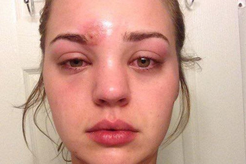 Cellulitis, czyli zapalenie tkanki łącznej, może być bardzo niebezpieczne dla zdrowia.