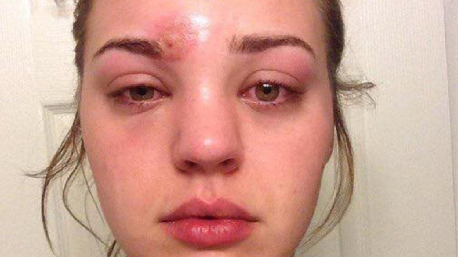 Cellulitis, czyli zapalenie tkanki łącznej, może być bardzo niebezpieczne dla zdrowia.