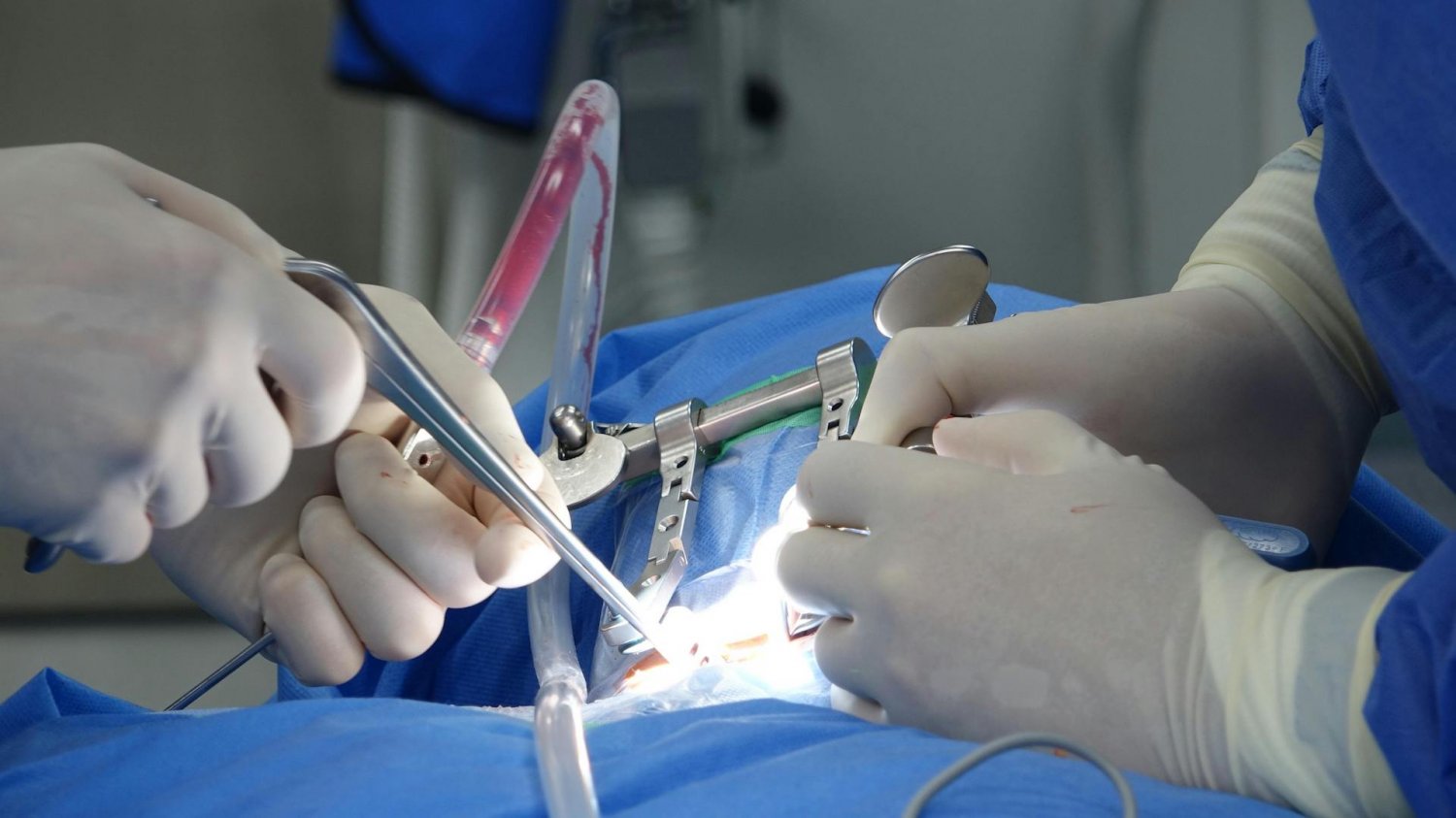 15-centymetrowe guzy jajników u nastolatki. "Operacja była niezwykle trudna"