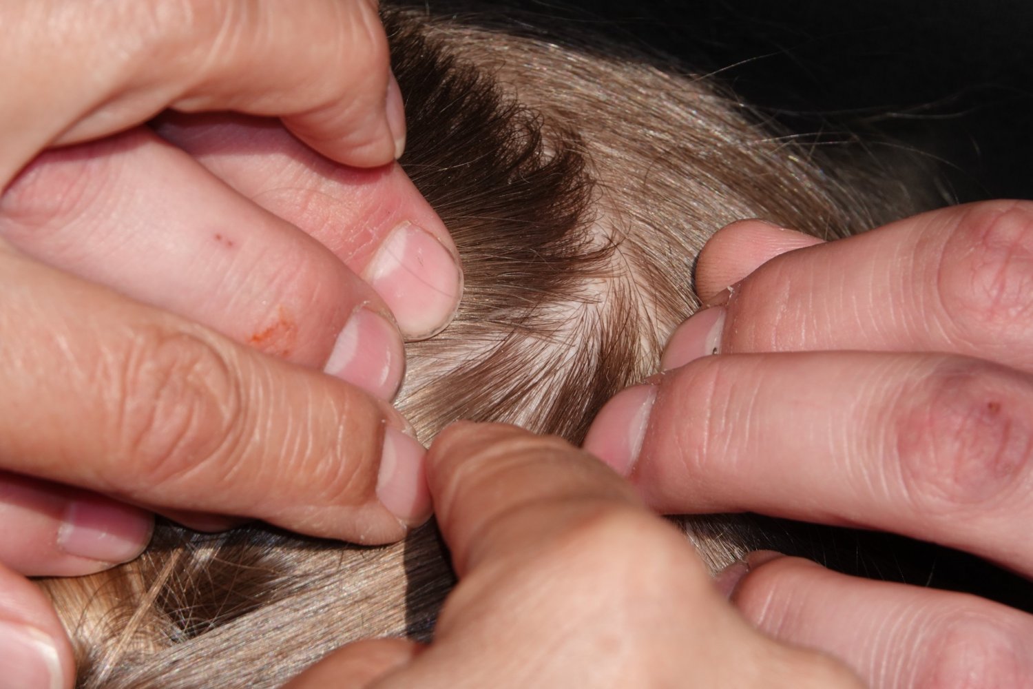 wszy i owsiki u dziecka