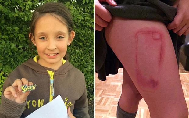 Fot. [url=http://www.telegraph.co.uk/news/newstopics/howaboutthat/12096634/Girl-nine-has-iPhone-shaped-scar-for-life-after-case-leaks-toxic-glitter-onto-her-leg.html] The Telegraph [/url]