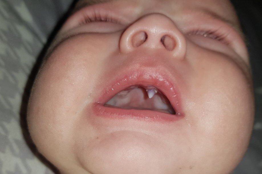 W buzi 11-tygodniowego chłopca w jedna noc wyrósł ząb